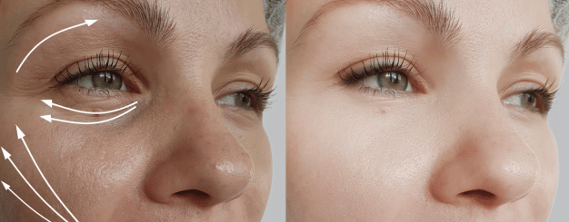 blefaroplastia