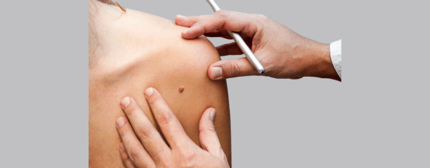 cirurgia-reparadora-de-cancer-de-pele